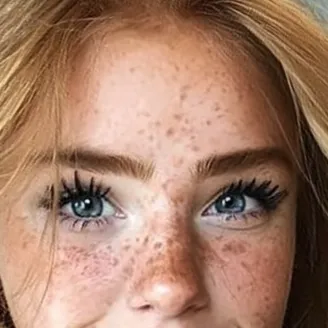 Freckles